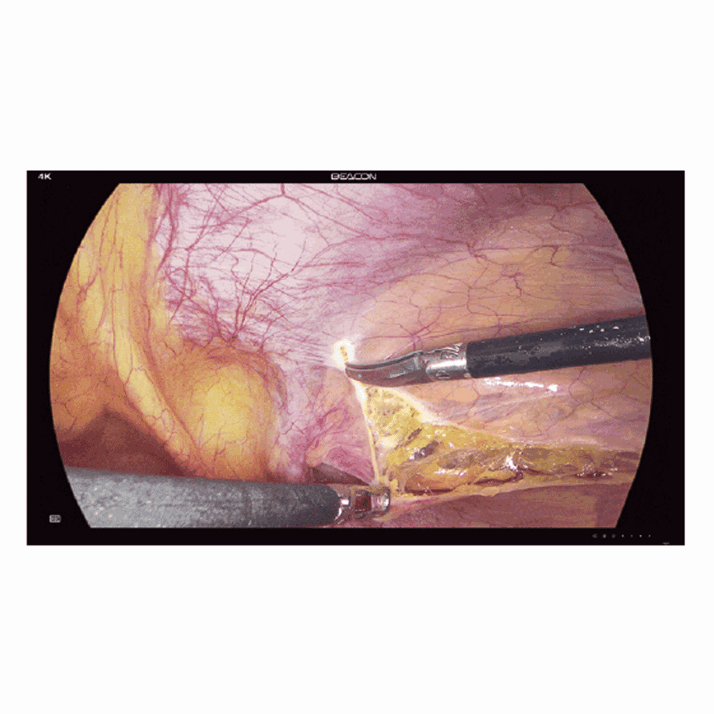 Beacon S4385P 4K Surgical Display